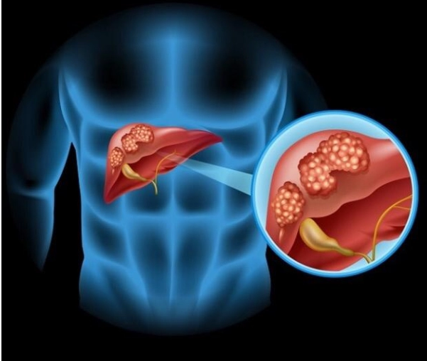 روش جدید درمان برای سرطان مجاری صفراوی